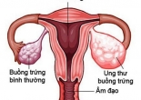 Những cơn đau cảnh báo sớm ung thư buồng trứng