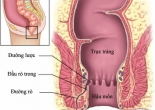 Rò hậu môn là bệnh gì?
