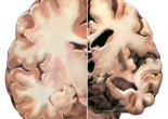 Mất ngủ có liên quan tới nguy cơ mắc bệnh Alzheimer