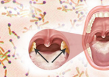 Không chủ quan với bệnh Bạch hầu