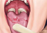 Cảnh giác với nhiều biến chứng nguy hiểm của bệnh Bạch hầu!