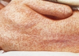 Hệ quả của phong trào “chống vắc-xin”: Dịch sởi bùng nổ trở lại ở châu Âu và Mỹ