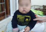 Bé trai suy thượng thận, mặt phù to như quả bí đỏ vì uống thuốc chứa corticoid