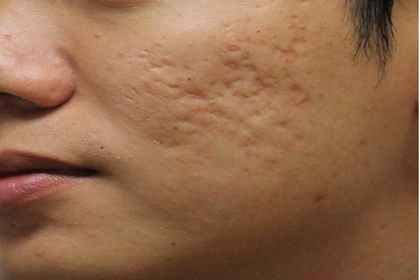 Cách tránh bị mụn trứng cá tổn thương da khi đeo khẩu trang ngừa COVID-19