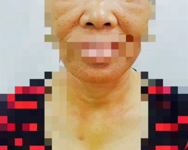 Lo lắng nguy cơ ung thư da trong mùa nắng nóng đến gần