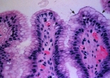 Lựa chọn kháng sinh trong điều trị bệnh lý dạ dày tá tràng do Helicobacter pylori