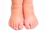 7 biện pháp tự nhiên giúp điều trị phù nề