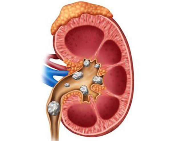 5 nguyên nhân chính khiến bạn bị sỏi thận, chớ coi thường!