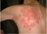 Bệnh do virut Herpes: Chữa trị thế nào?