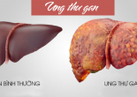 Điểm mặt đồng minh của ung thư gan