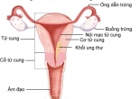 Những yếu tố nguy cơ gây ung thư nội mạc tử cung